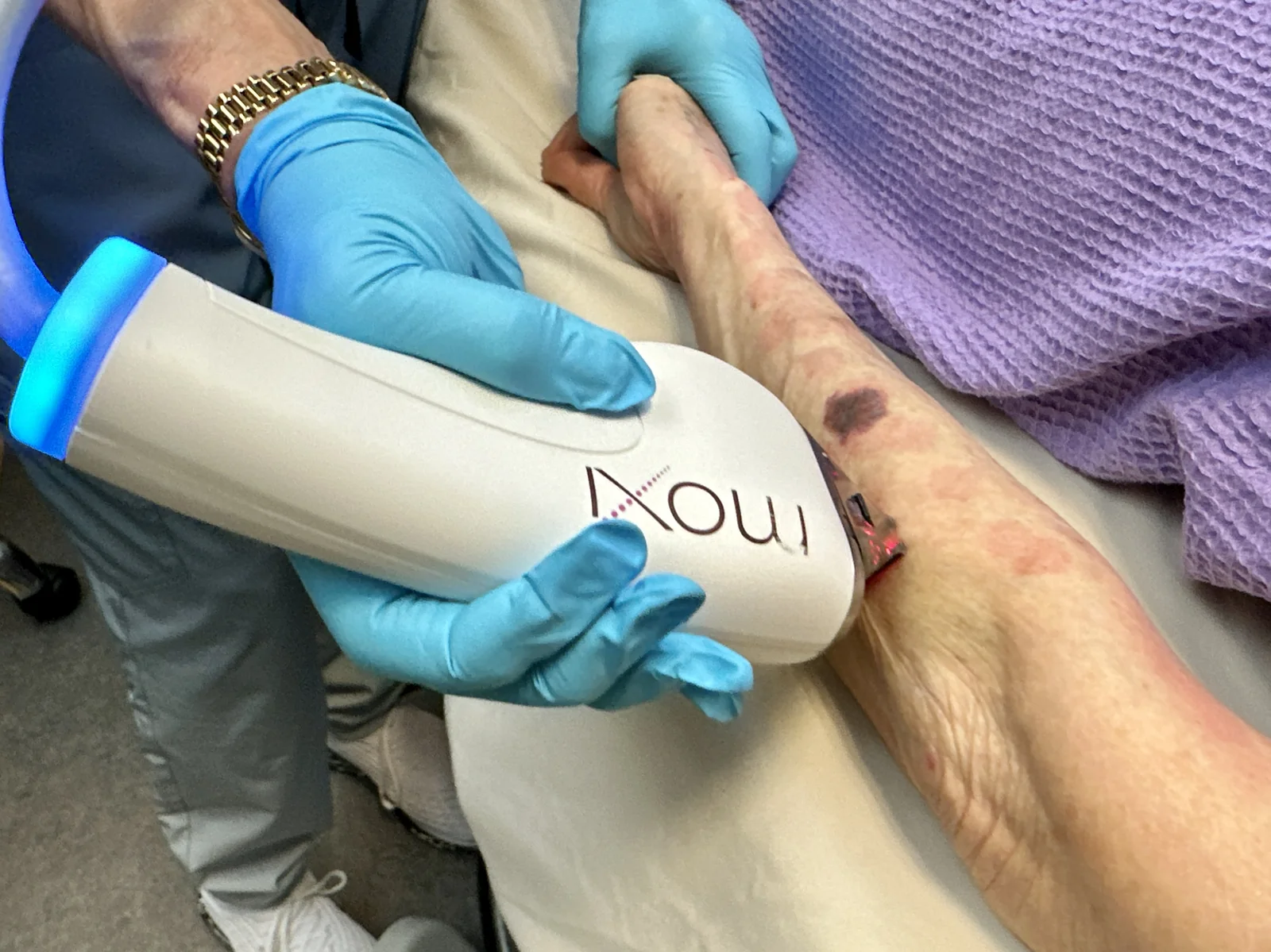 A MOXI laser session treating sun damage on the forearm at Reviv Med Spa in Millbrae