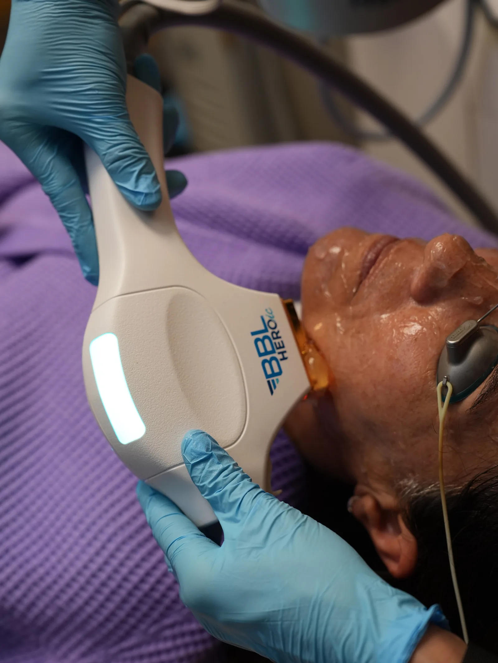 The Sciton BBL HERO handpiece on the cheek during a photofacial at Reviv Med Spa, Millbrae