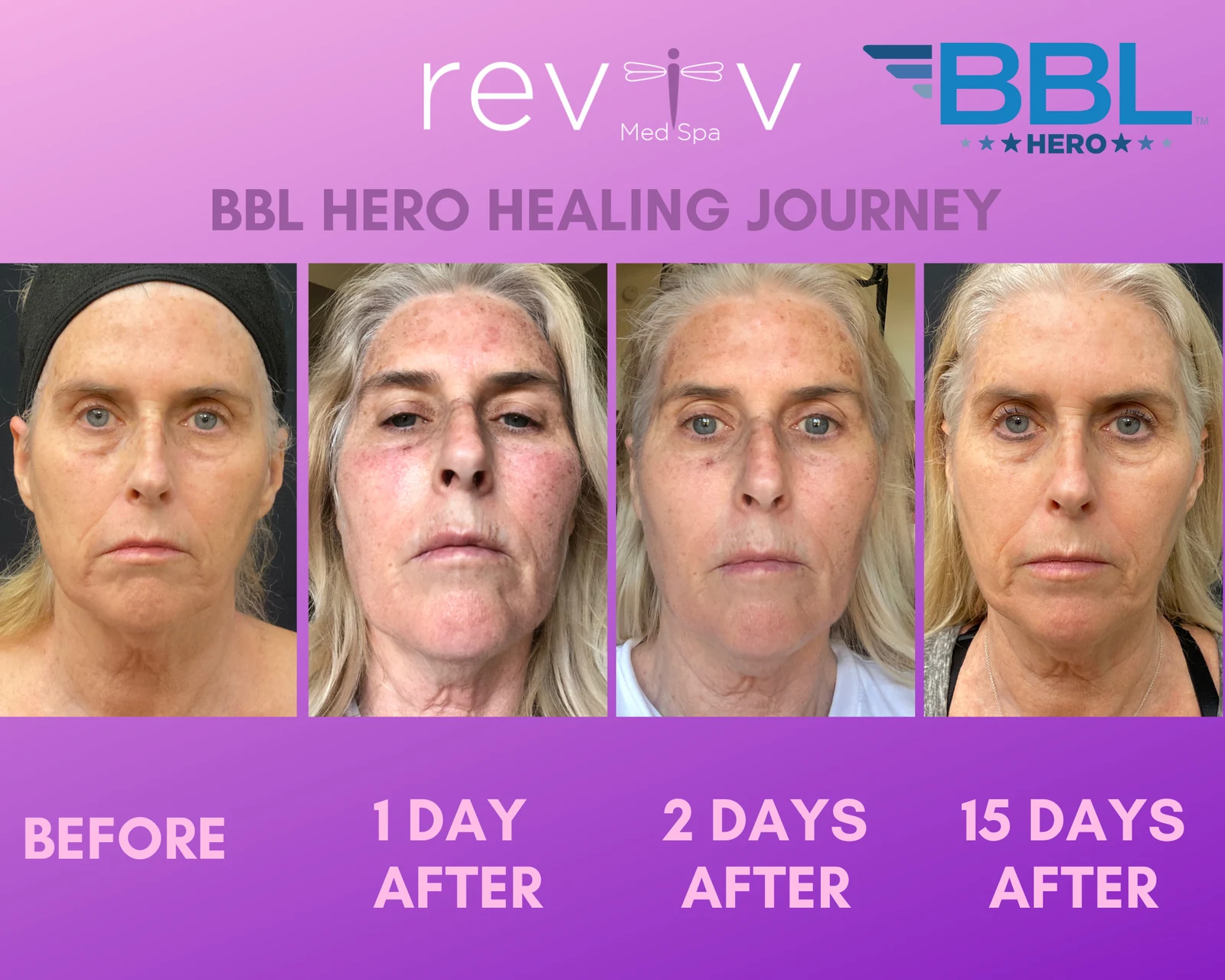 Reviv Med Spa patient before and after — BBL Hero, Millbrae, California