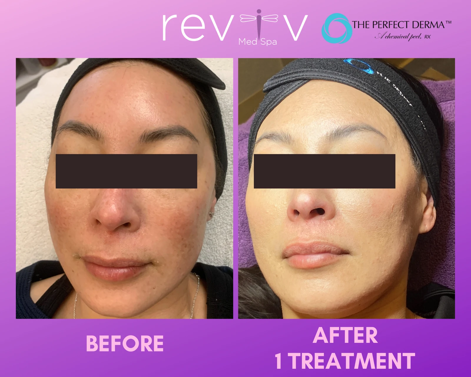 Reviv Med Spa patient before and after — Chemical Peel, Millbrae, California