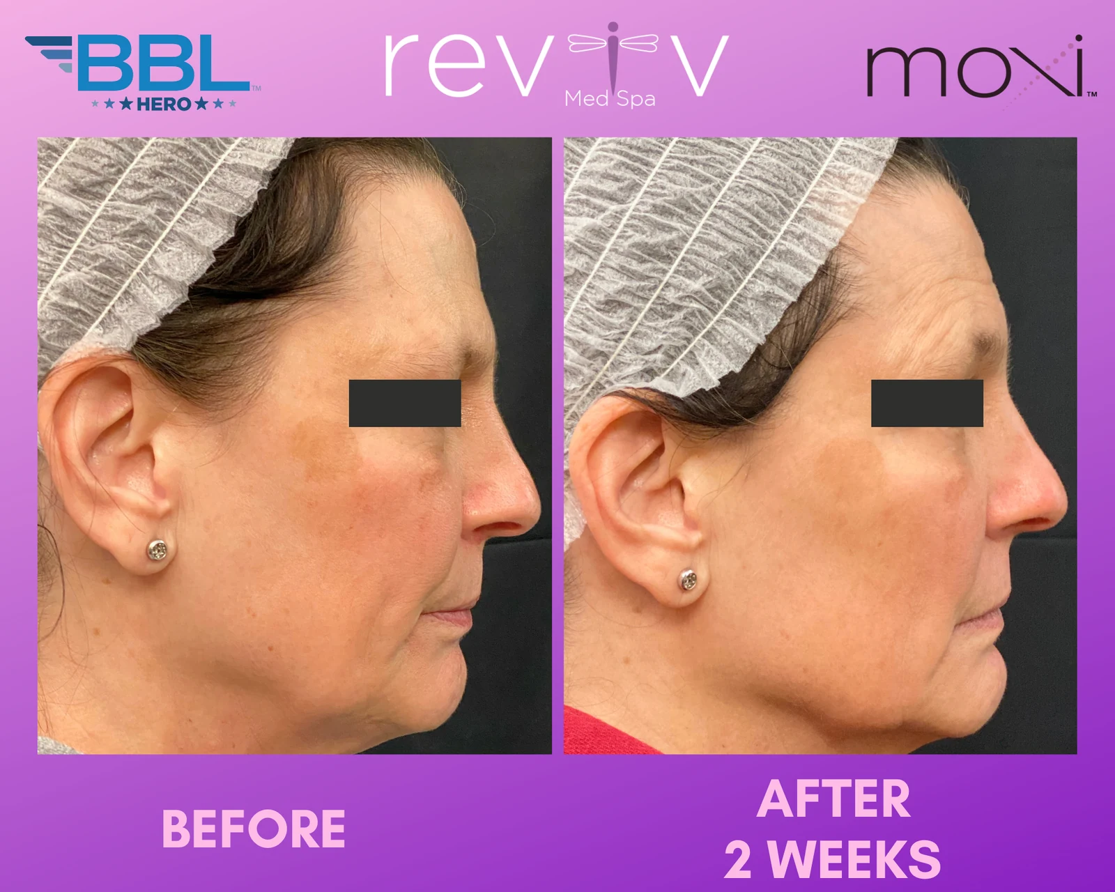 Reviv Med Spa patient before and after — BBL + MOXI, Millbrae, California