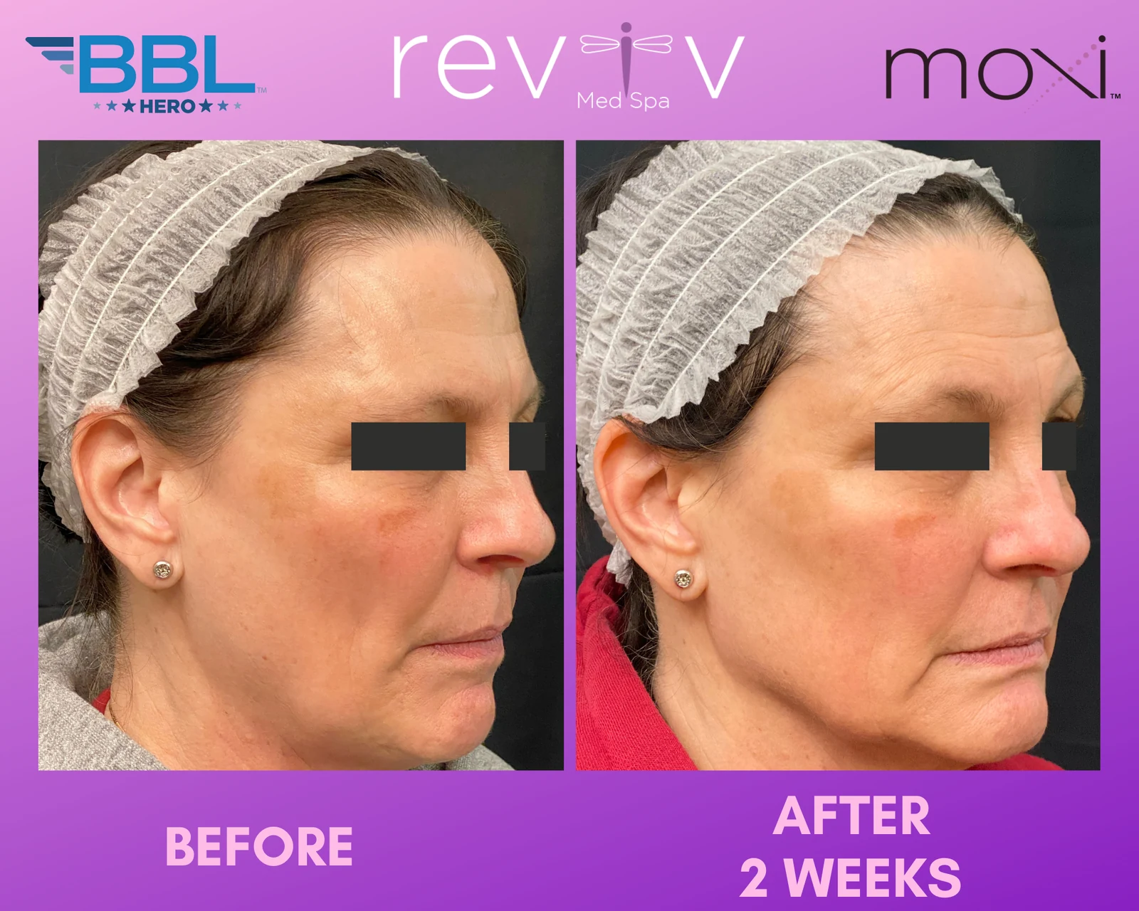Reviv Med Spa patient before and after — BBL + MOXI, Millbrae, California