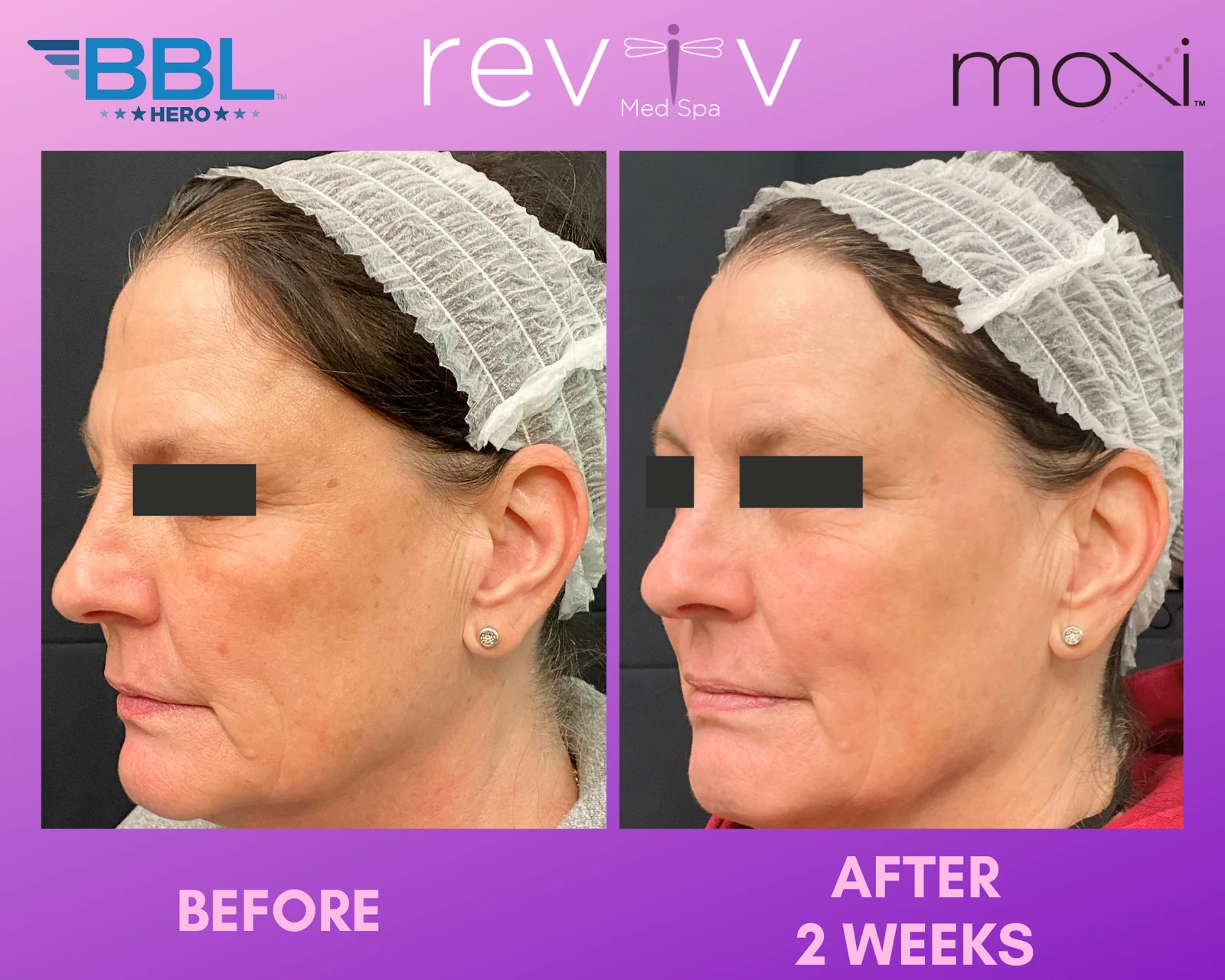 Reviv Med Spa patient before and after — BBL + MOXI, Millbrae, California