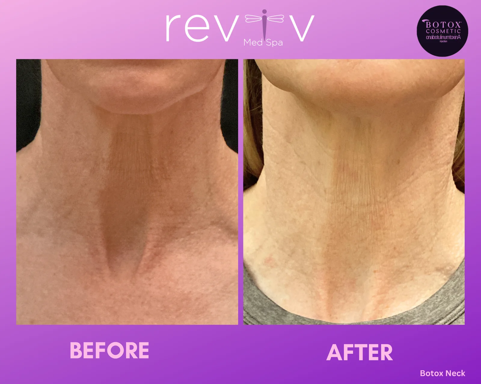 Botox neck before and after at Reviv Med Spa, Millbrae — smoother platysmal bands and neck lines
