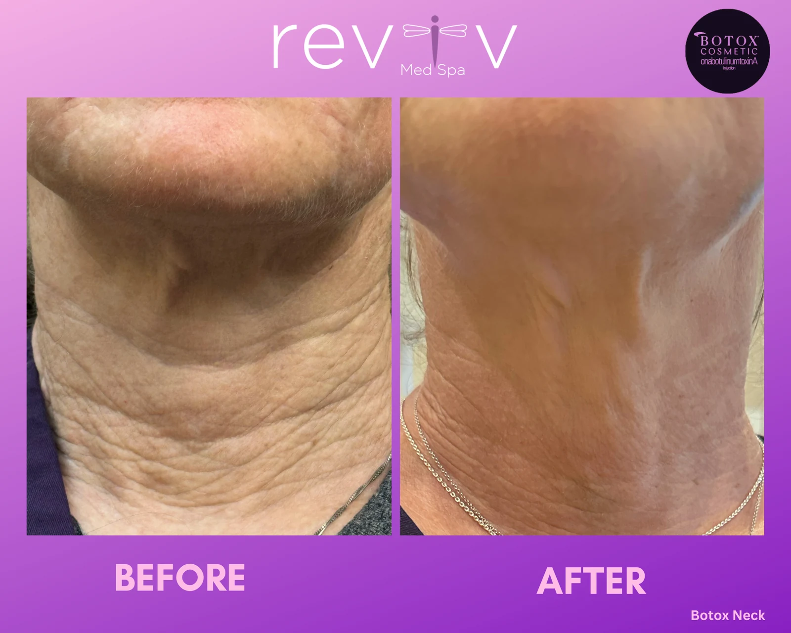 Botox · neck contour