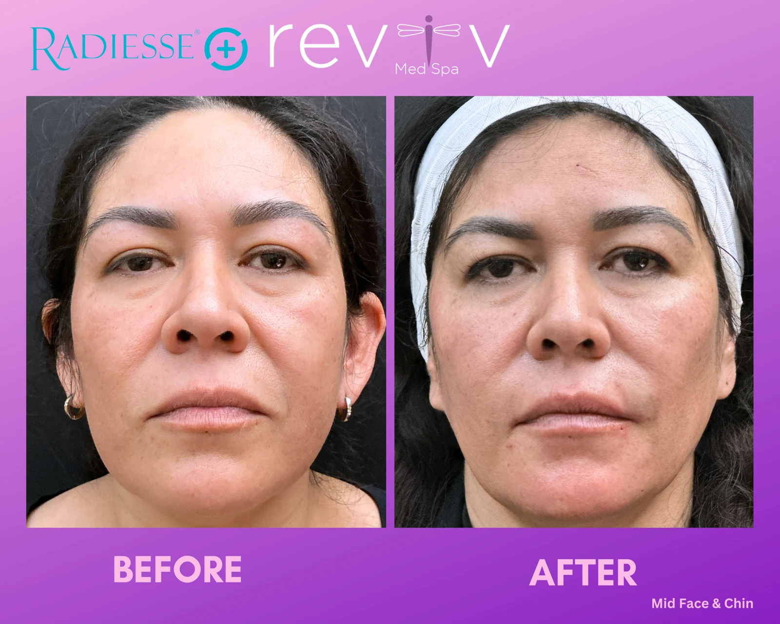 Reviv Med Spa patient before and after — Dermal Fillers, Millbrae, California