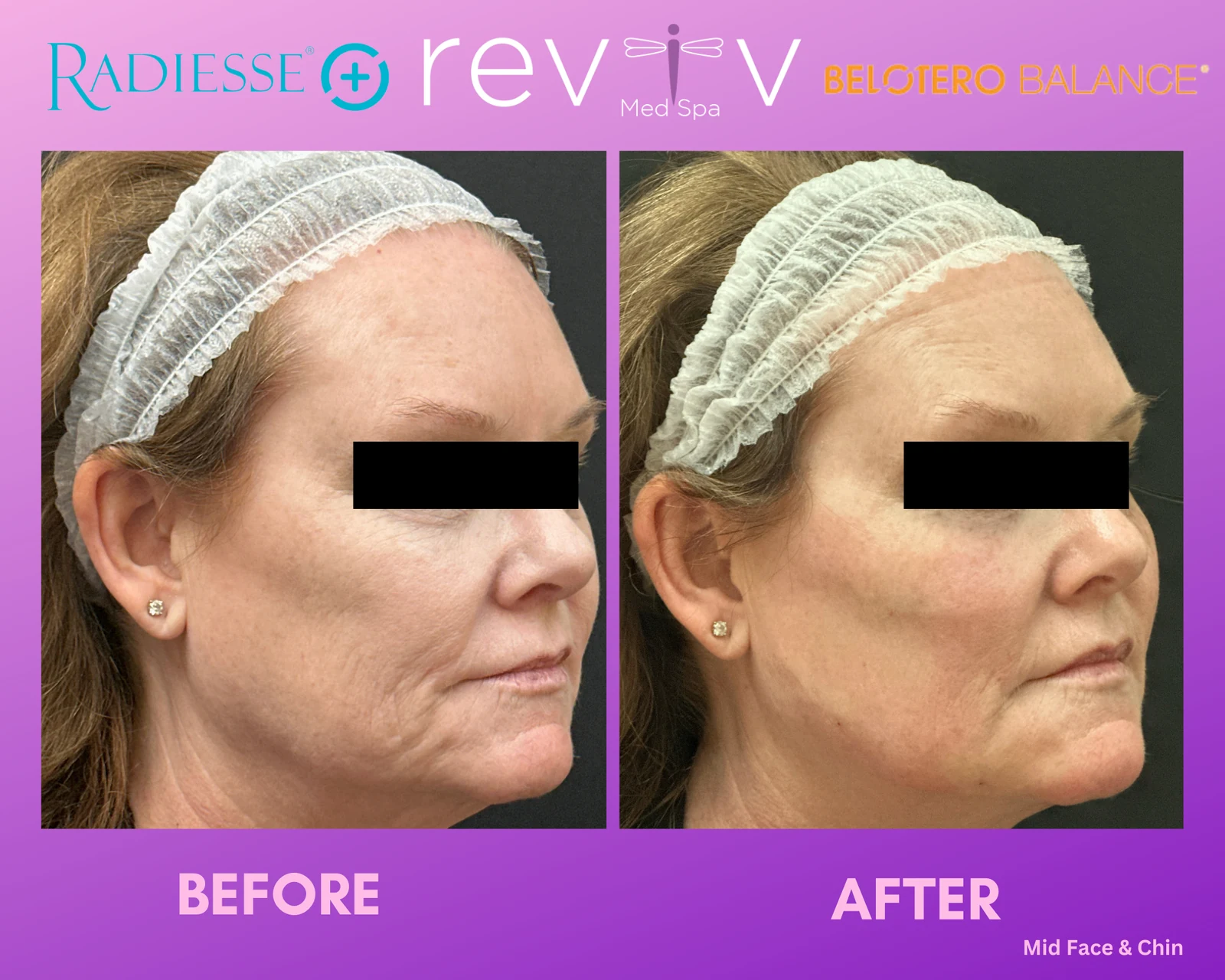Reviv Med Spa patient before and after — Dermal Fillers, Millbrae, California