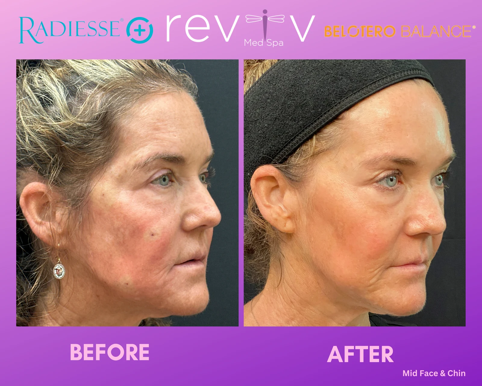 Reviv Med Spa patient before and after — Dermal Fillers, Millbrae, California