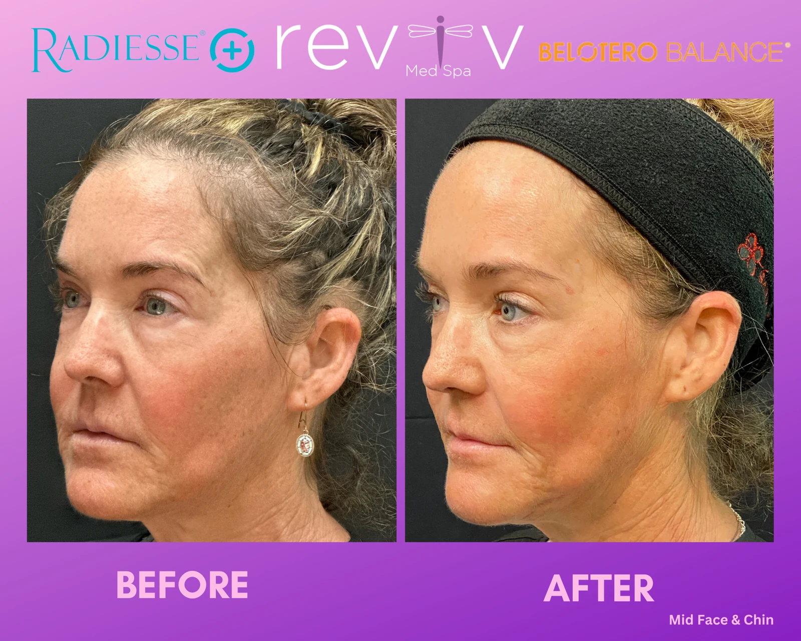 Reviv Med Spa patient before and after — Dermal Fillers, Millbrae, California