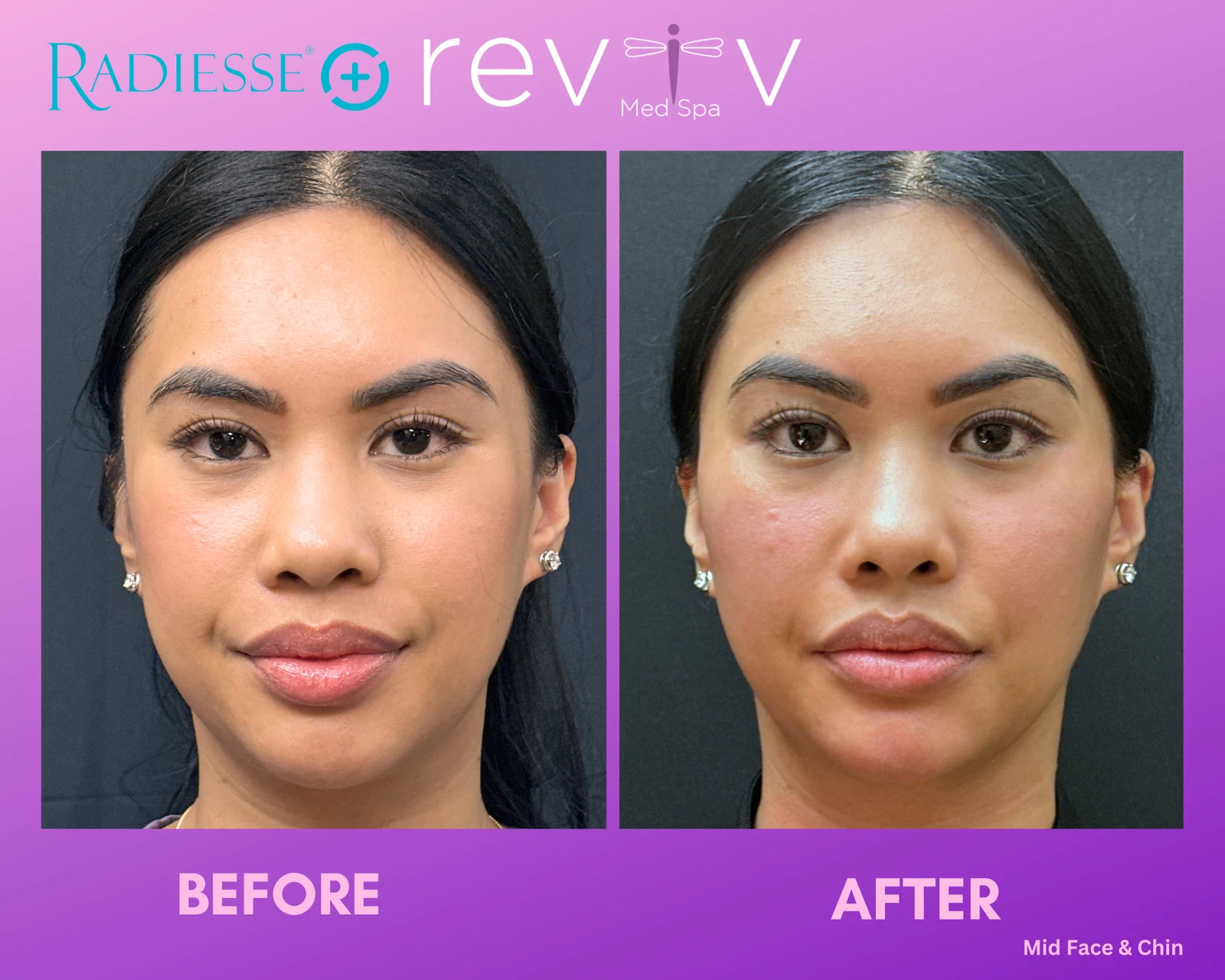 Reviv Med Spa patient before and after — Dermal Fillers, Millbrae, California