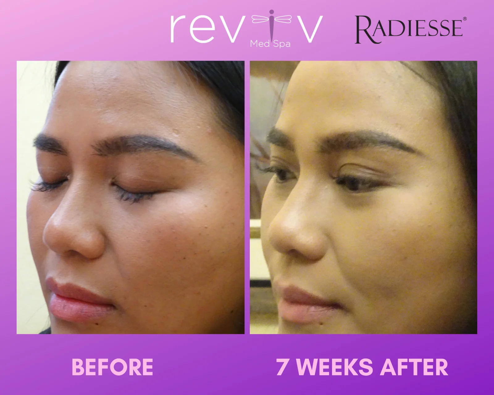 Reviv Med Spa patient before and after — Dermal Fillers, Millbrae, California