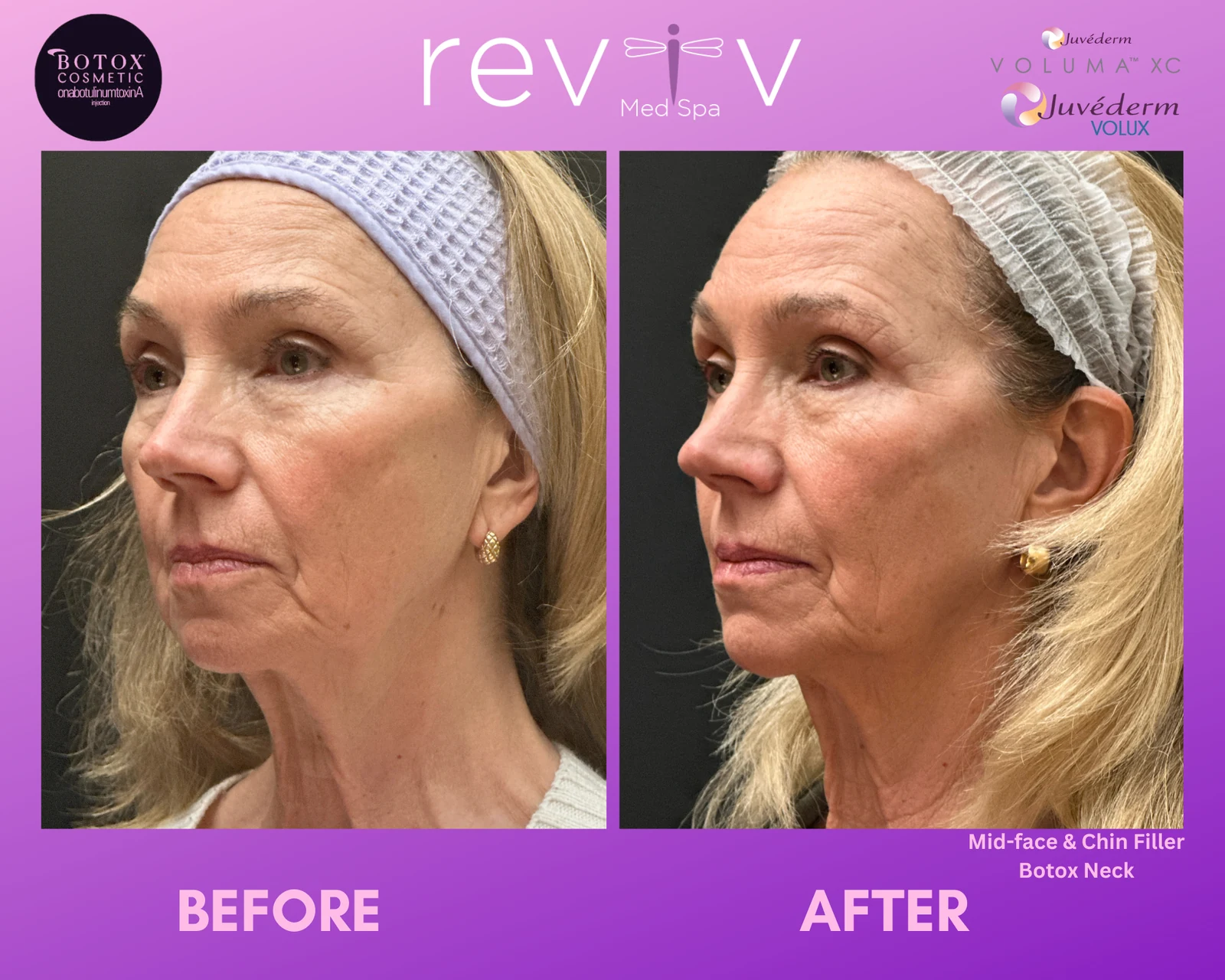 Reviv Med Spa patient before and after — Dermal Fillers, Millbrae, California