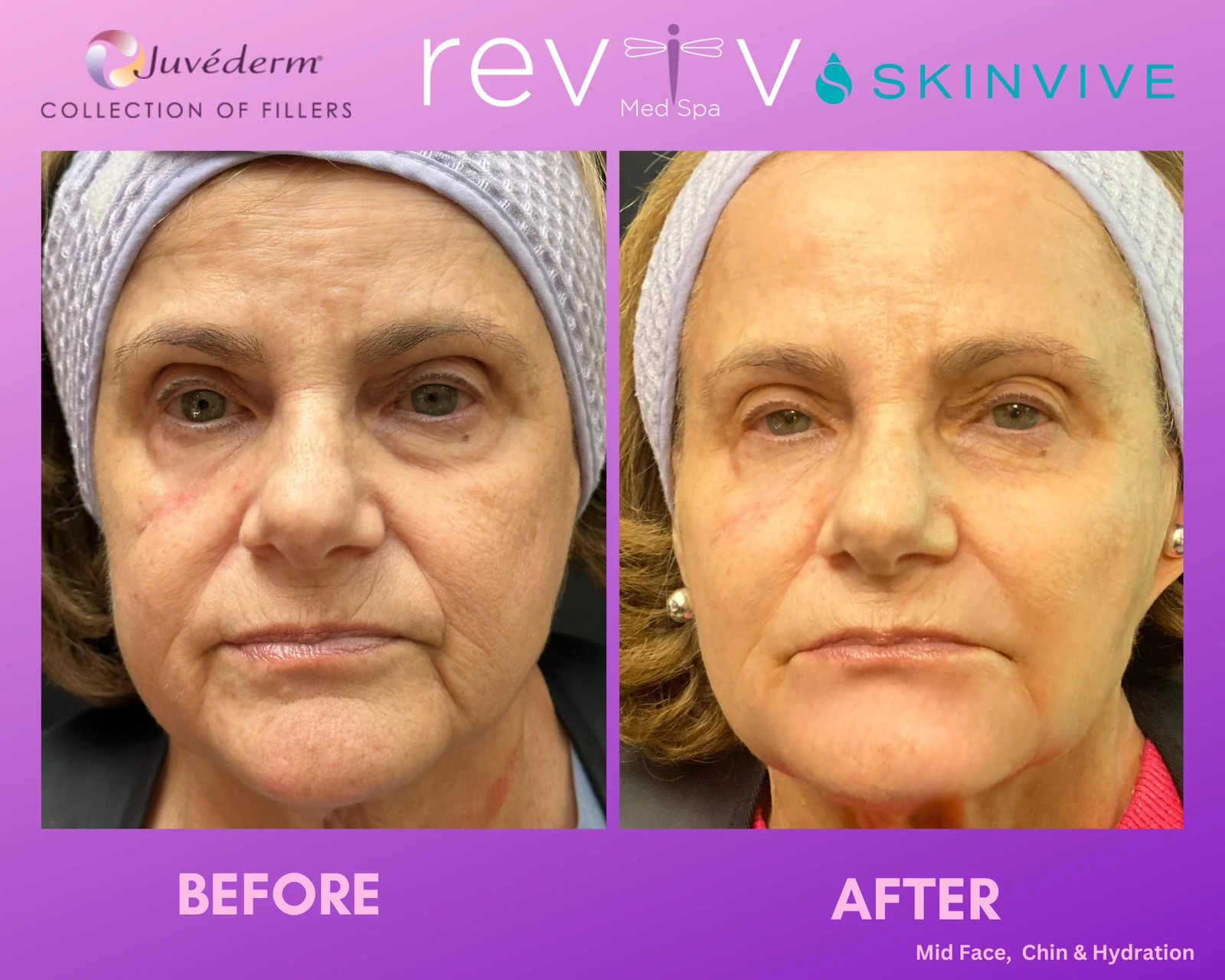 Reviv Med Spa patient before and after — Dermal Fillers, Millbrae, California