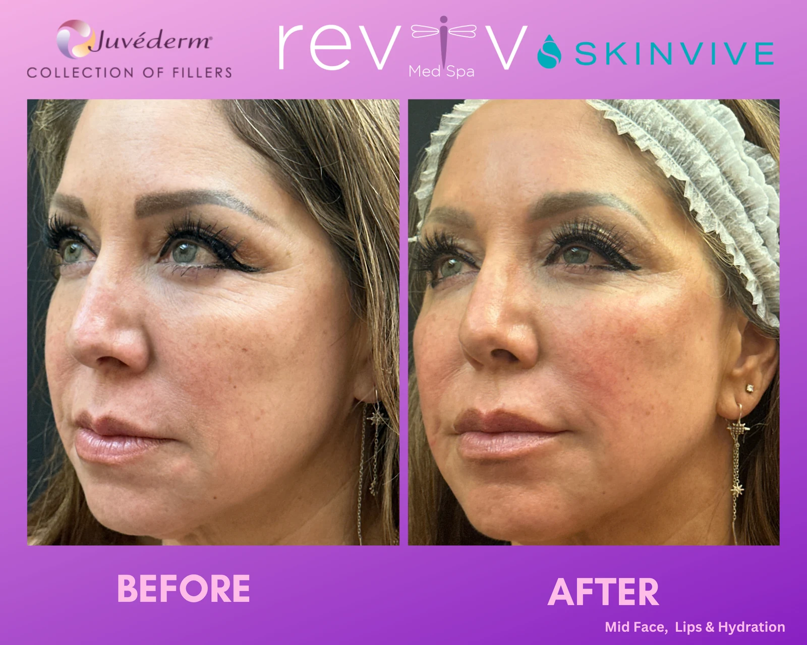 Reviv Med Spa patient before and after — Dermal Fillers, Millbrae, California