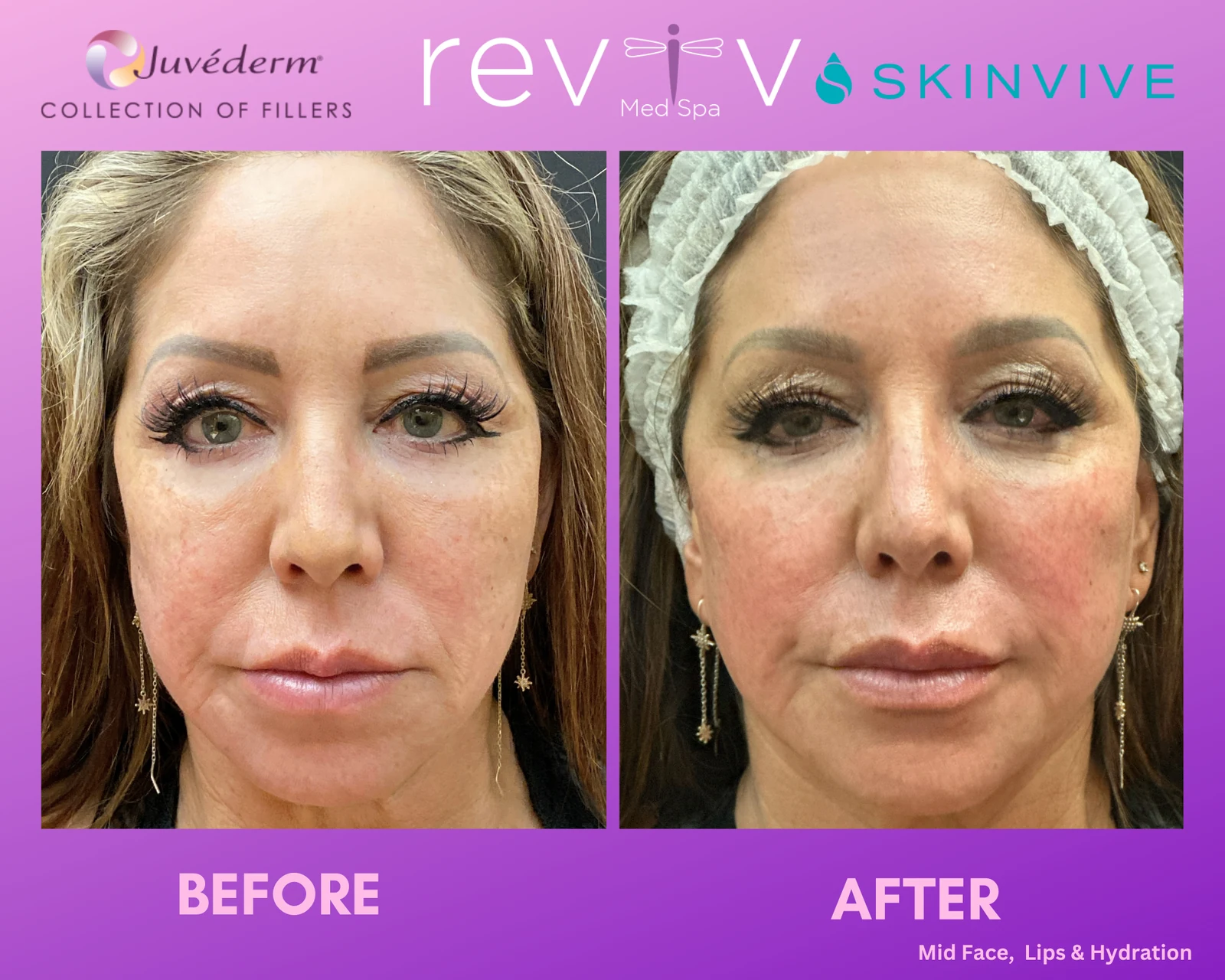 Reviv Med Spa patient before and after — Dermal Fillers, Millbrae, California