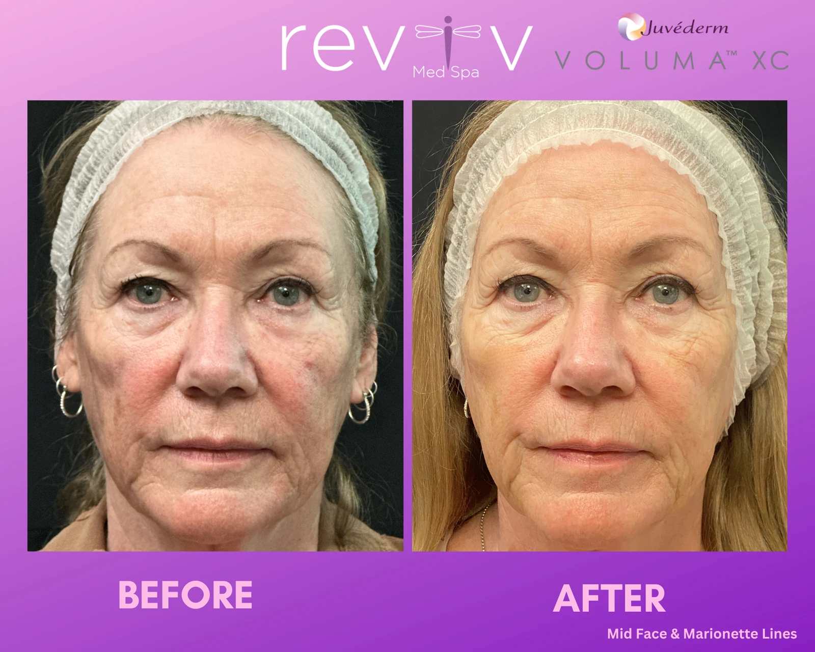 Reviv Med Spa patient before and after — Dermal Fillers, Millbrae, California