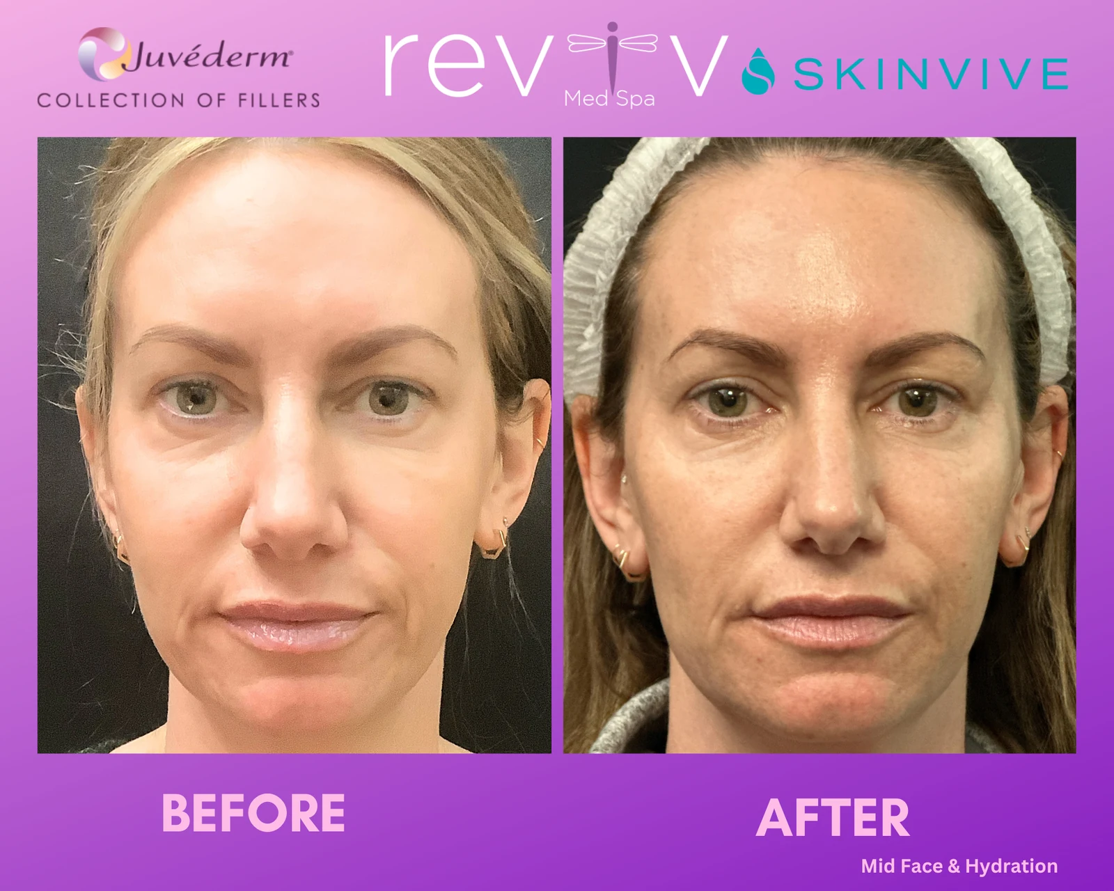 Reviv Med Spa patient before and after — Skinvive, Millbrae, California