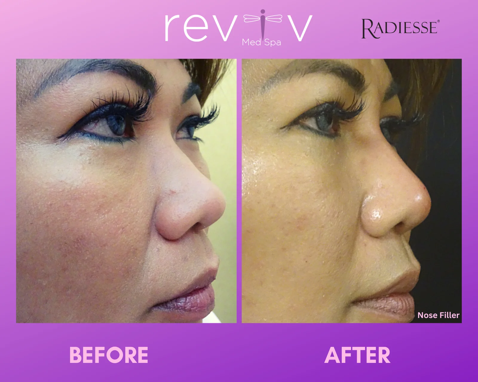 Reviv Med Spa patient before and after — Dermal Fillers, Millbrae, California