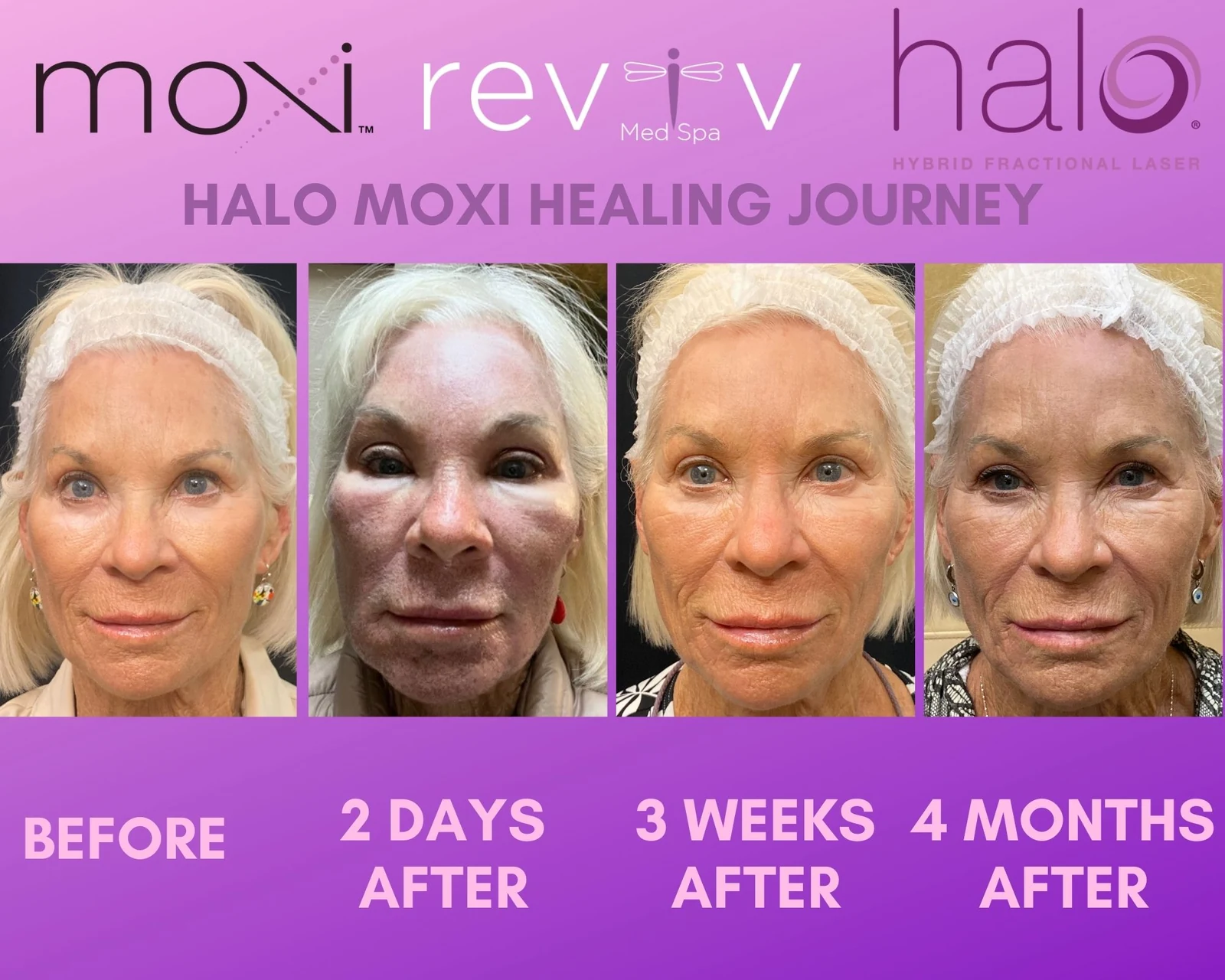 Reviv Med Spa patient before and after — Halo + MOXI, Millbrae, California