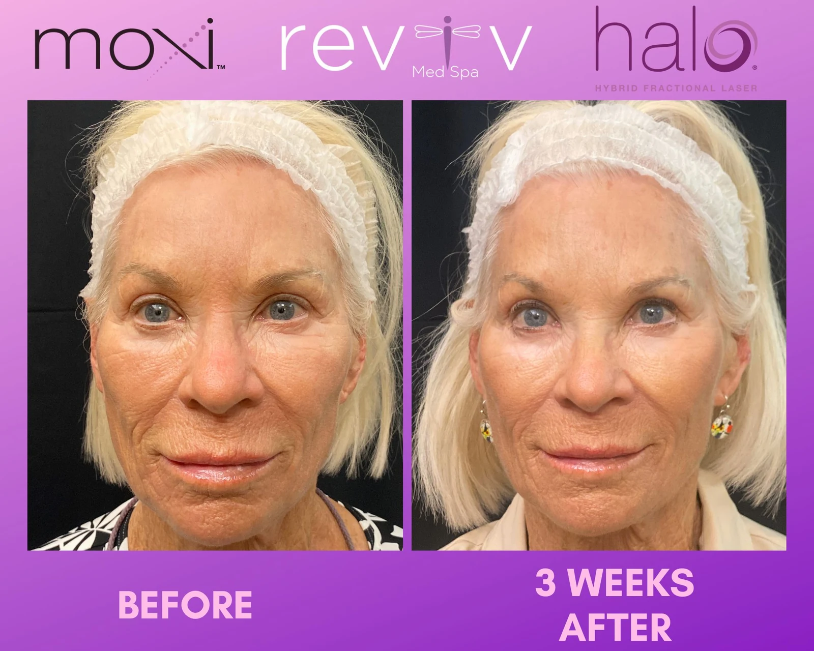 Reviv Med Spa patient before and after — Halo + MOXI, Millbrae, California
