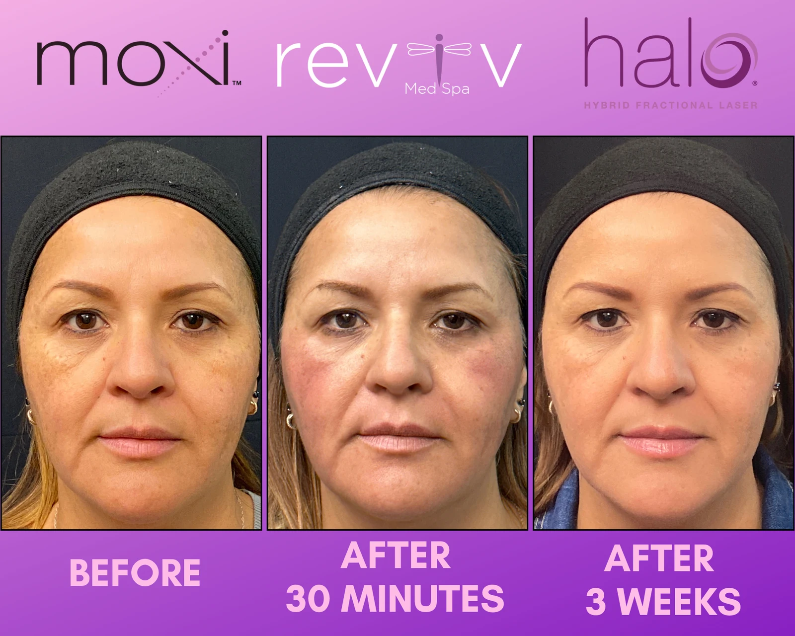 Reviv Med Spa patient before and after — Halo + MOXI, Millbrae, California