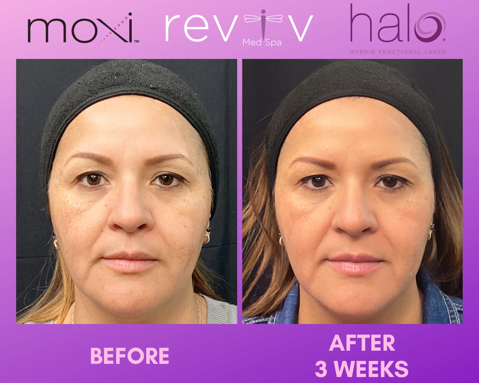 Reviv Med Spa patient before and after — Halo + MOXI, Millbrae, California