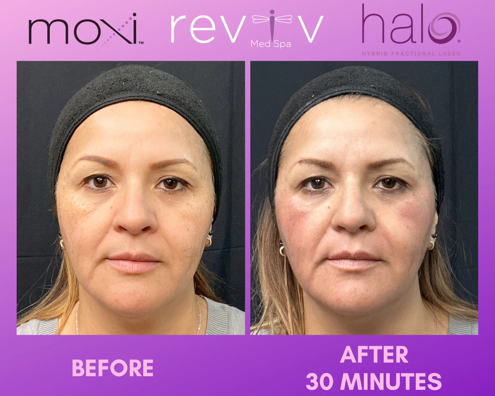 Reviv Med Spa patient before and after — Halo + MOXI, Millbrae, California