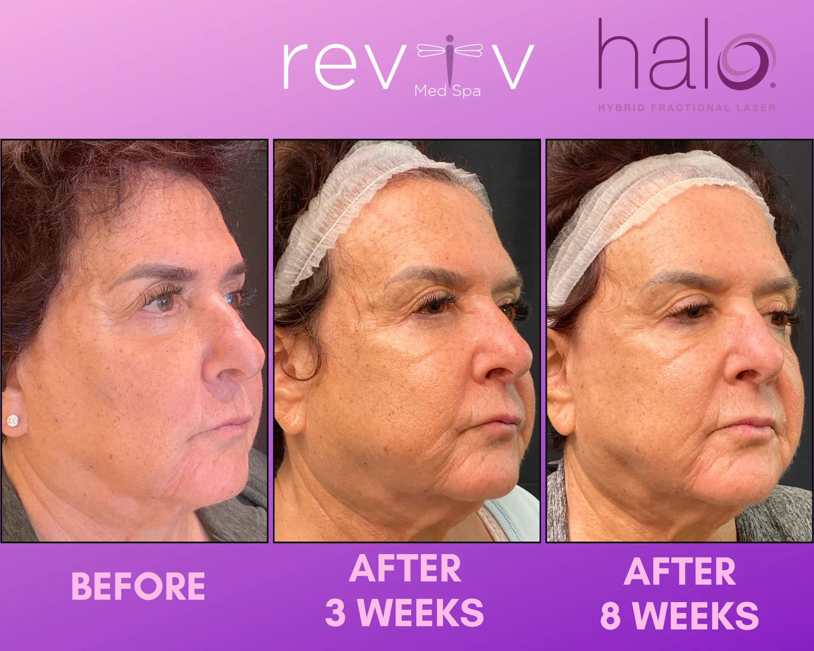 Reviv Med Spa patient before and after — Halo, Millbrae, California