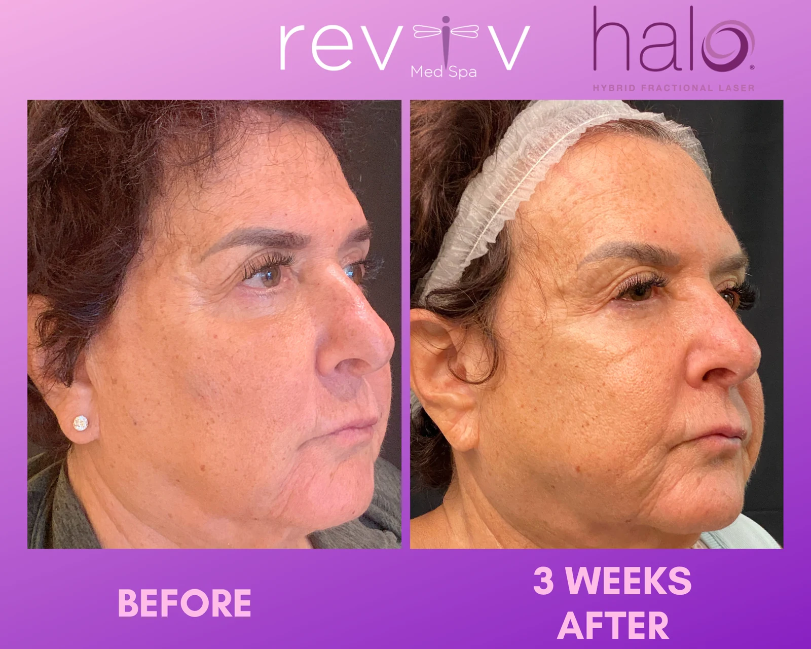 Reviv Med Spa patient before and after — Halo, Millbrae, California