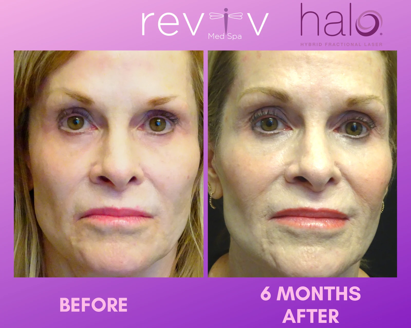 Reviv Med Spa patient before and after — Halo, Millbrae, California