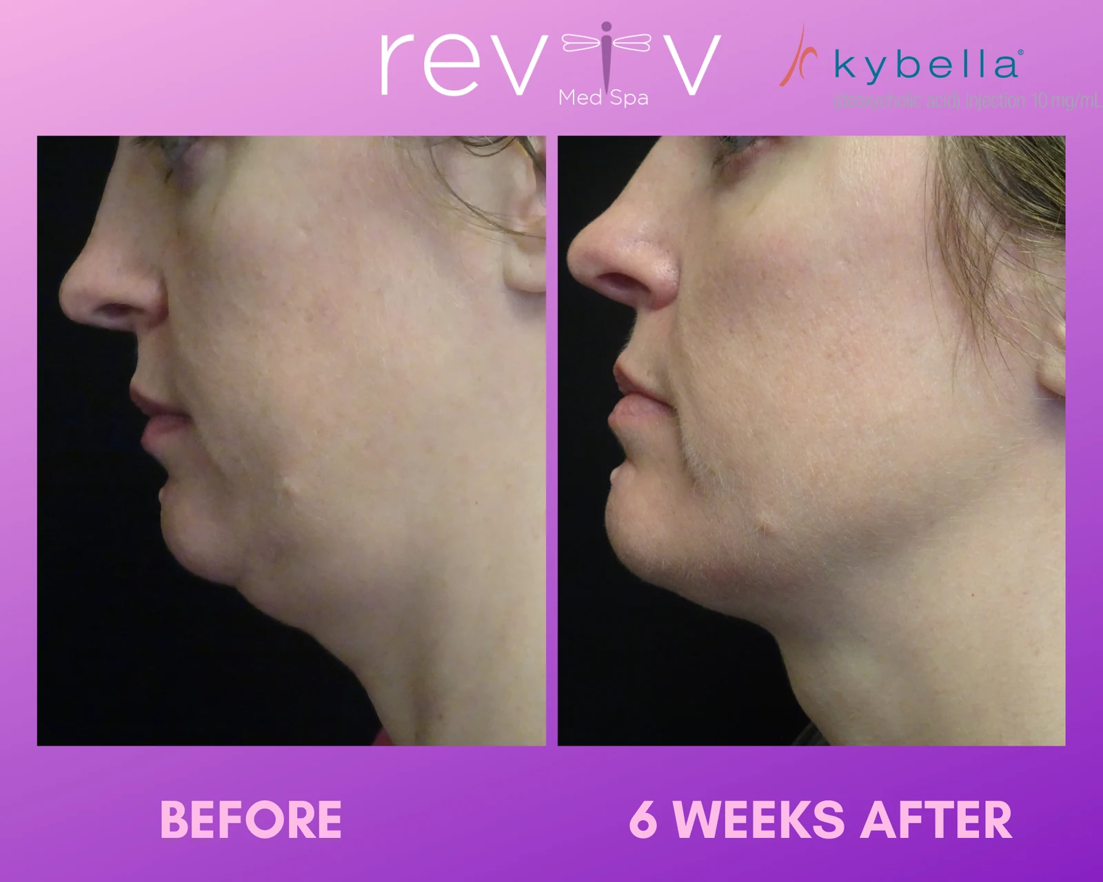 Reviv Med Spa patient before and after — Kybella, Millbrae, California