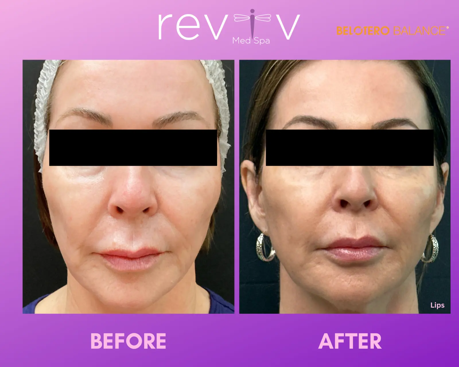 Lip enhancement · Belotero Balance