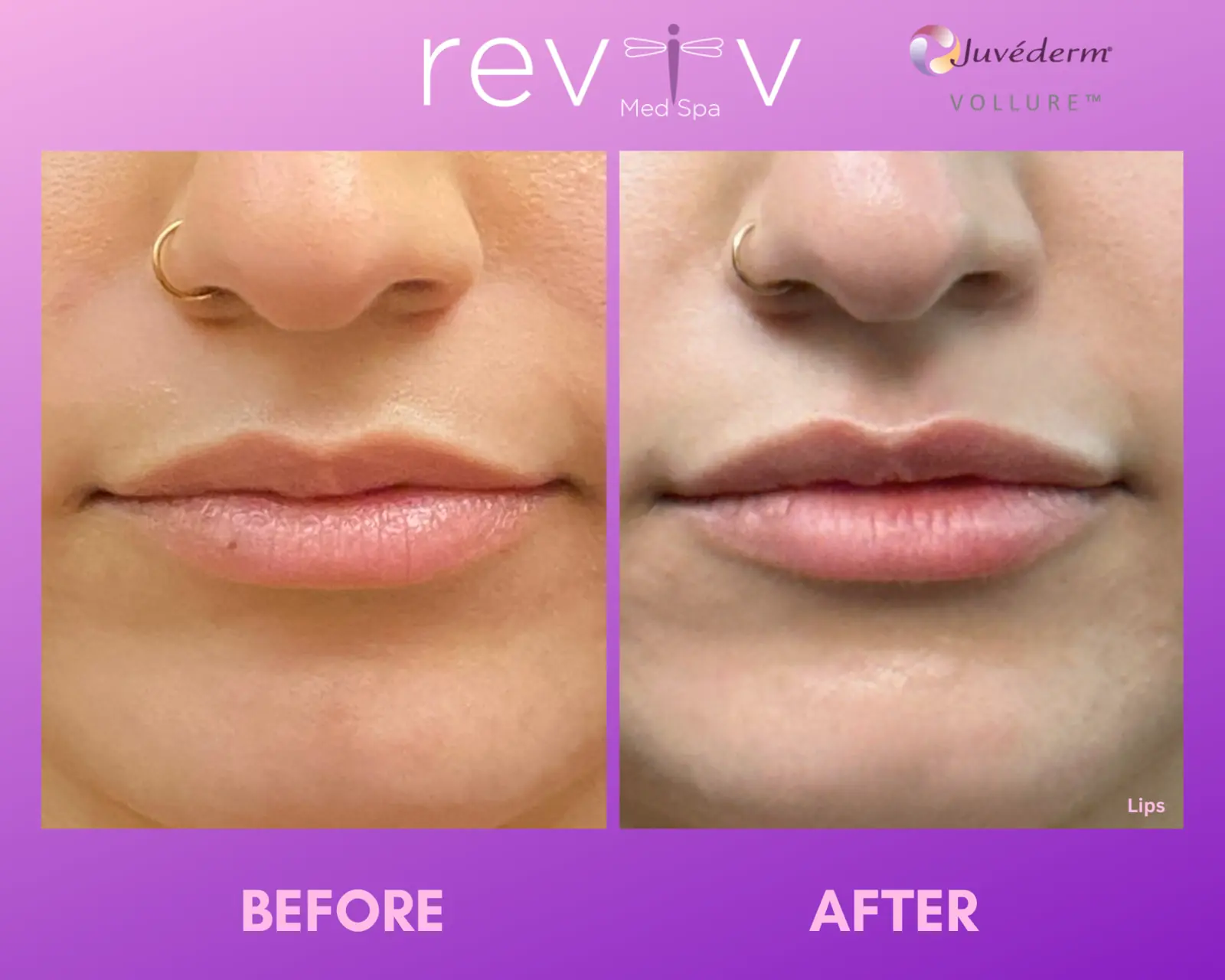 Lip filler with Juvéderm Vollure, before and after