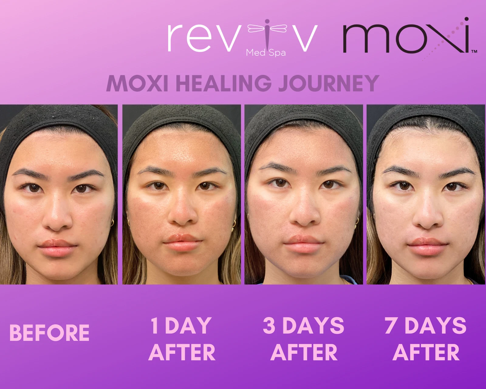 Reviv Med Spa patient before and after — MOXI, Millbrae, California