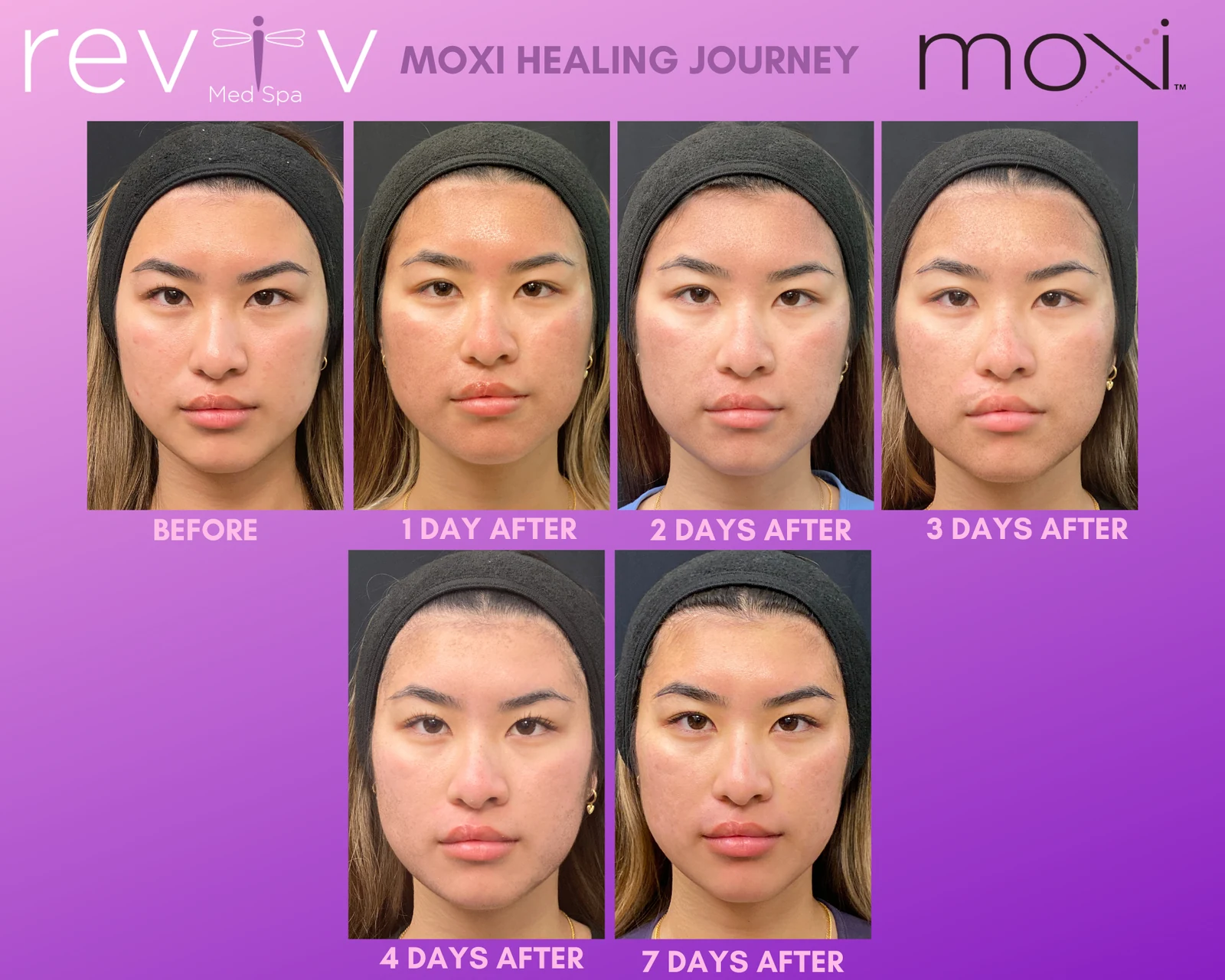 Reviv Med Spa patient before and after — MOXI, Millbrae, California
