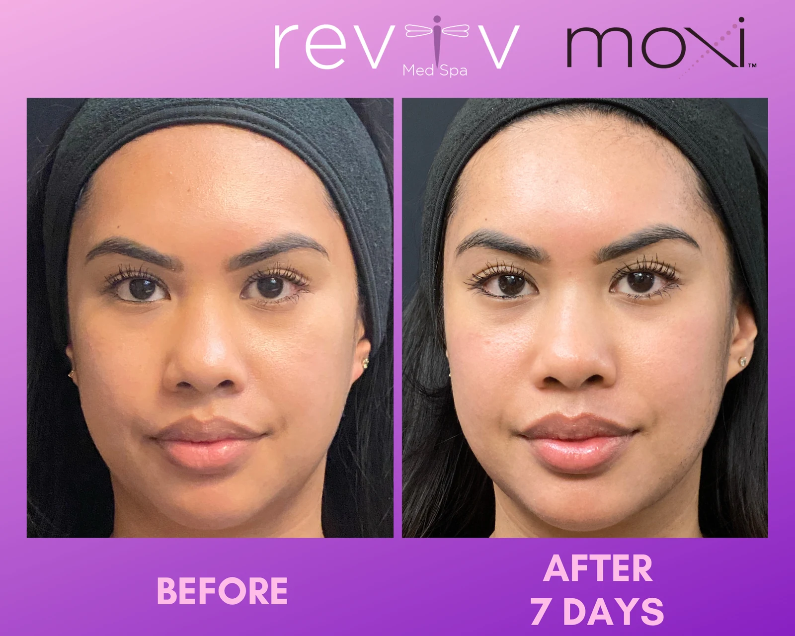 Reviv Med Spa patient before and after — MOXI, Millbrae, California