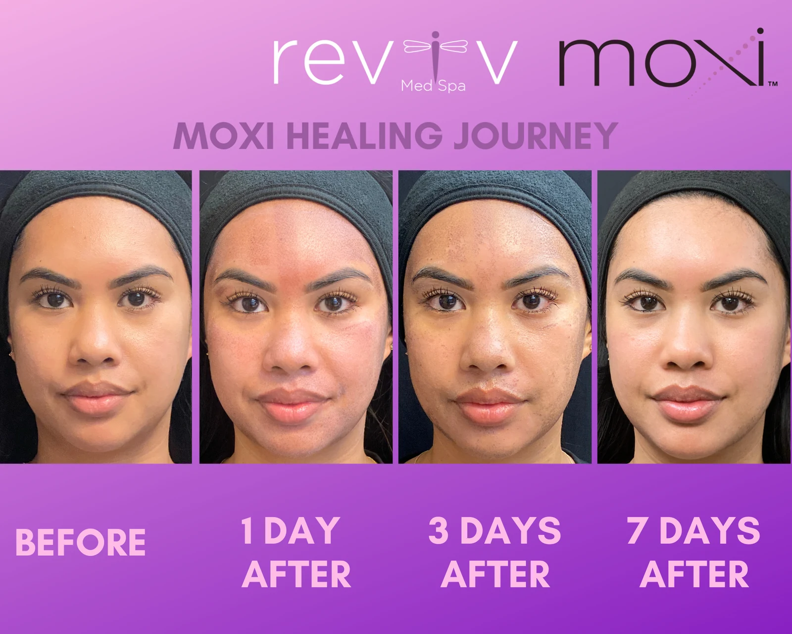 Reviv Med Spa patient before and after — MOXI, Millbrae, California