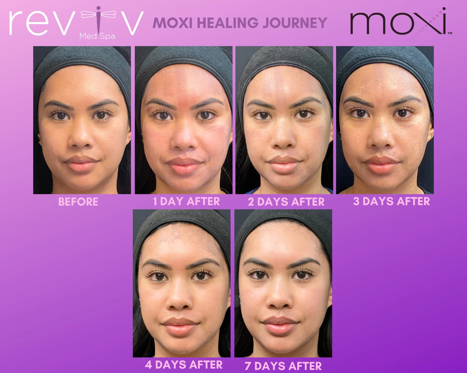 Reviv Med Spa patient before and after — MOXI, Millbrae, California