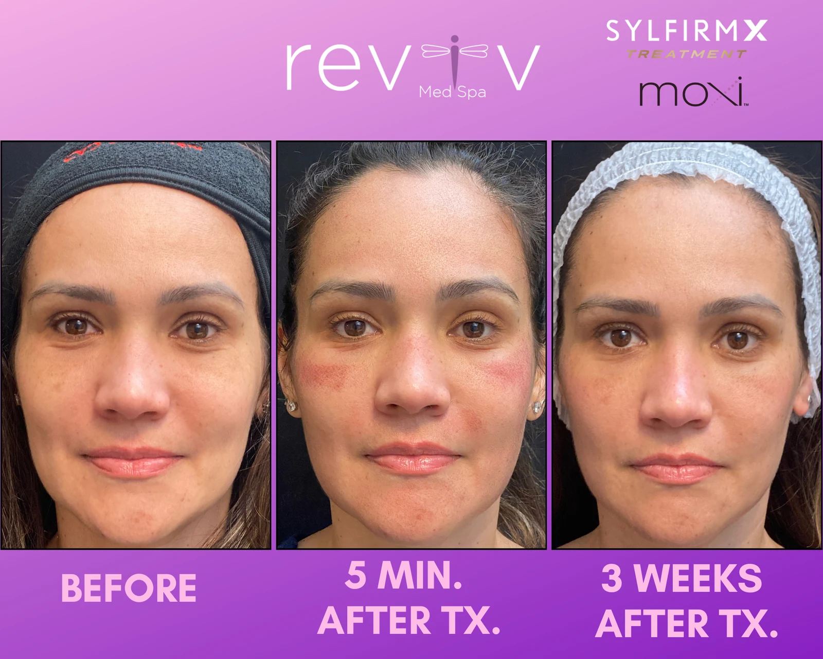 Reviv Med Spa patient before and after — MOXI + Sylfirm, Millbrae, California