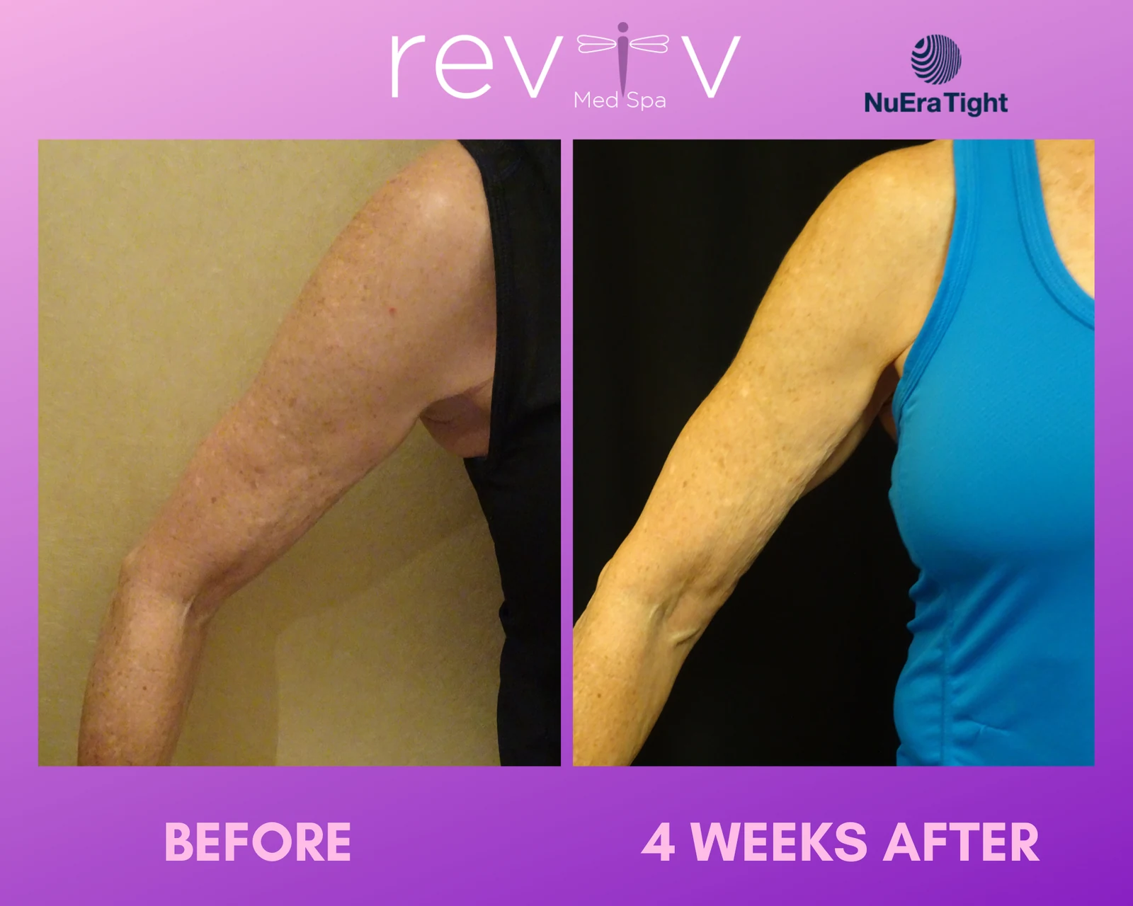 Reviv Med Spa patient before and after — NuEra Tight RF, Millbrae, California