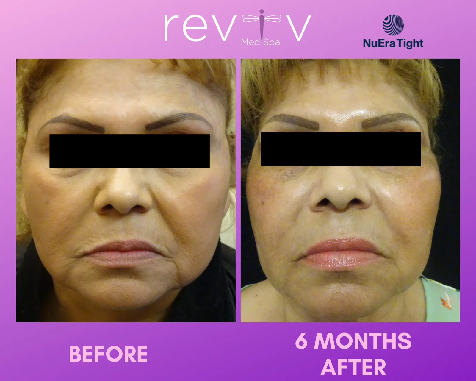 Reviv Med Spa patient before and after — NuEra Tight RF, Millbrae, California