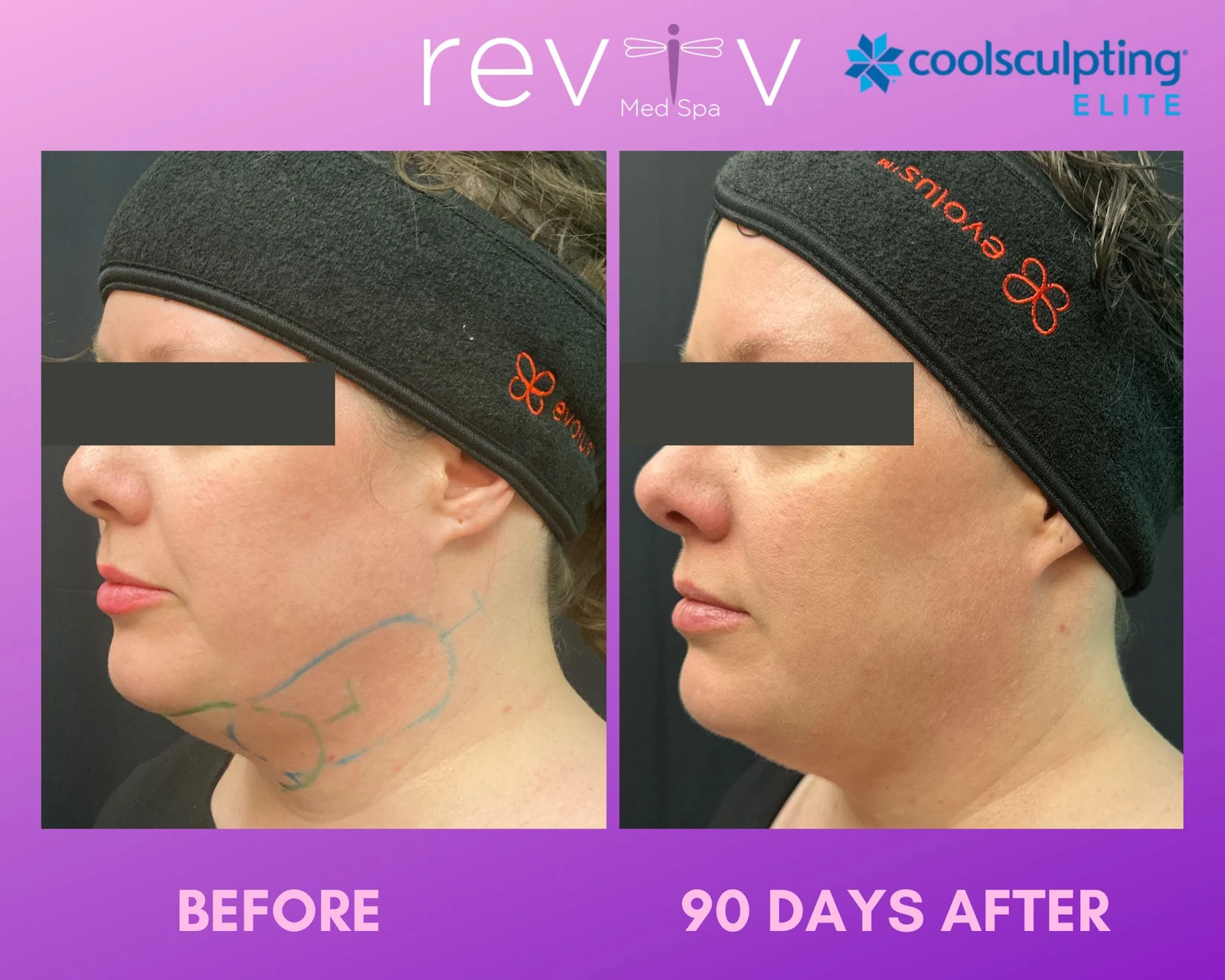 Reviv patient — CoolSculpting Elite (undefined)