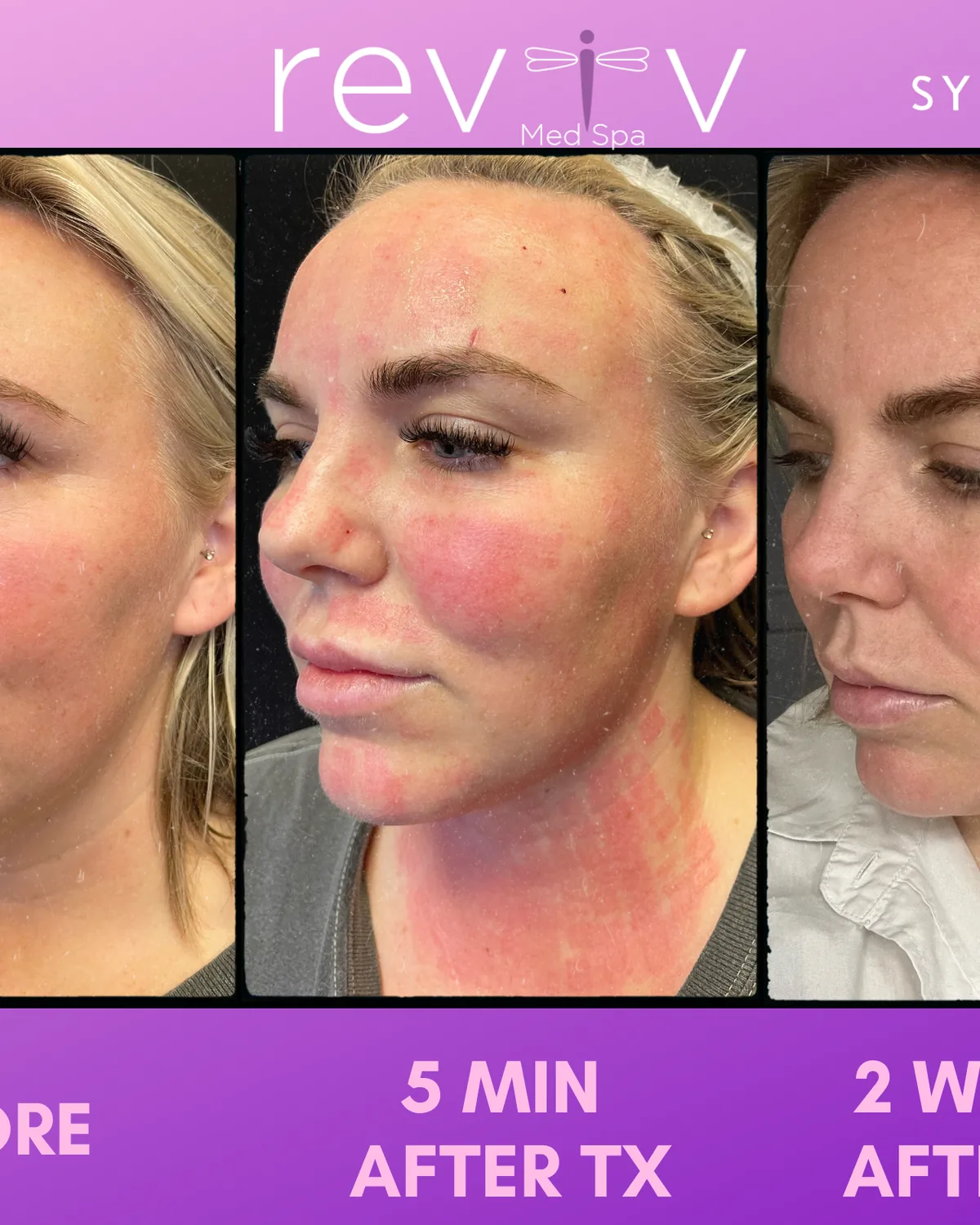 Reviv patient — Sylfirm X (undefined)