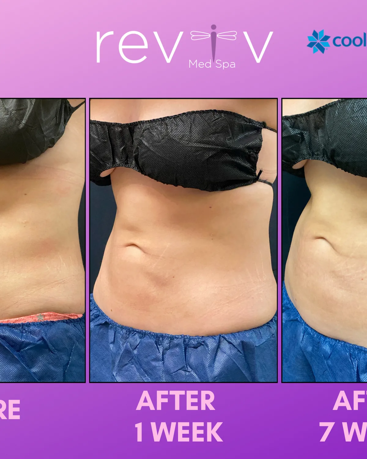 Reviv patient — CoolSculpting Elite (undefined)