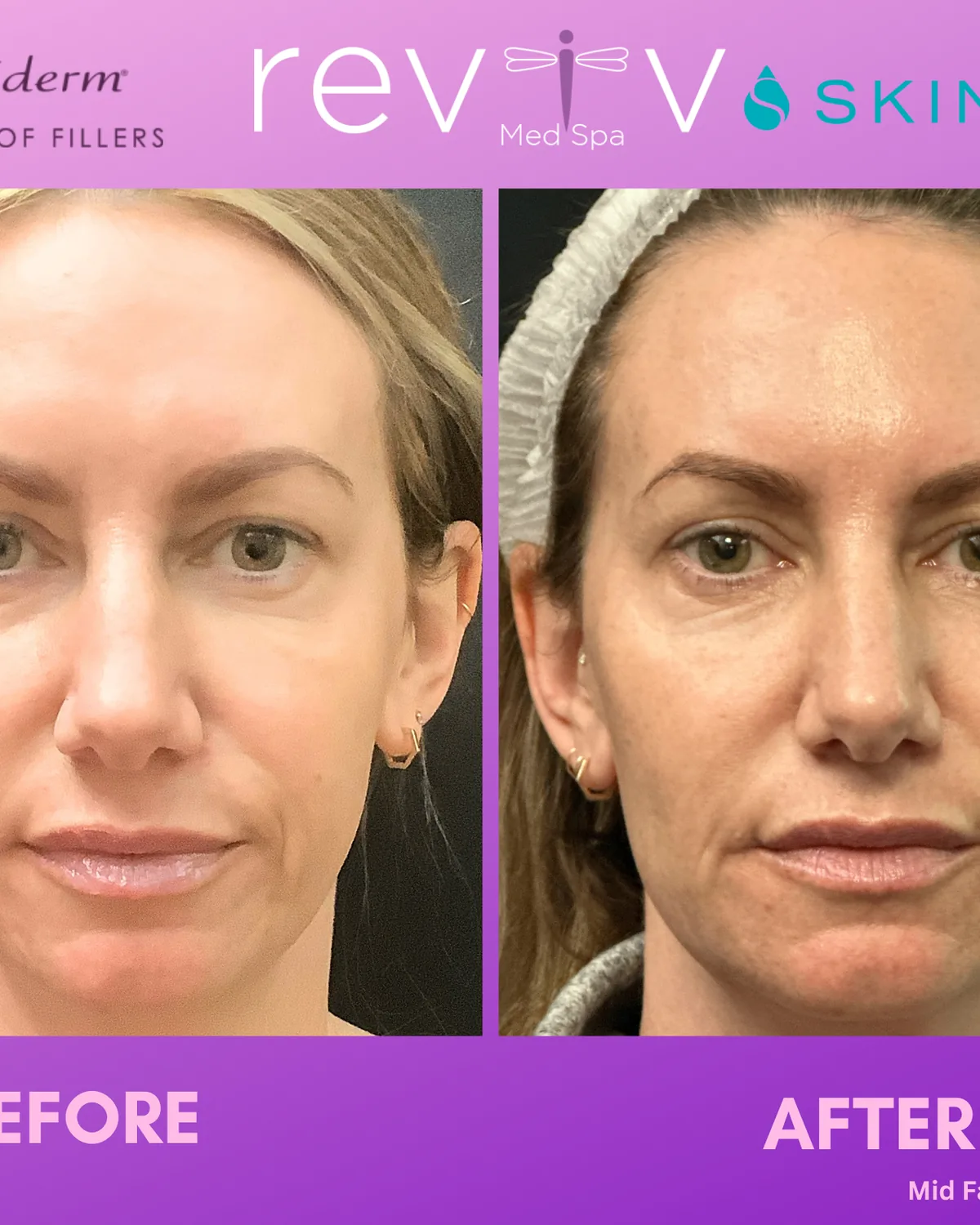 Reviv patient — Skinvive (undefined)