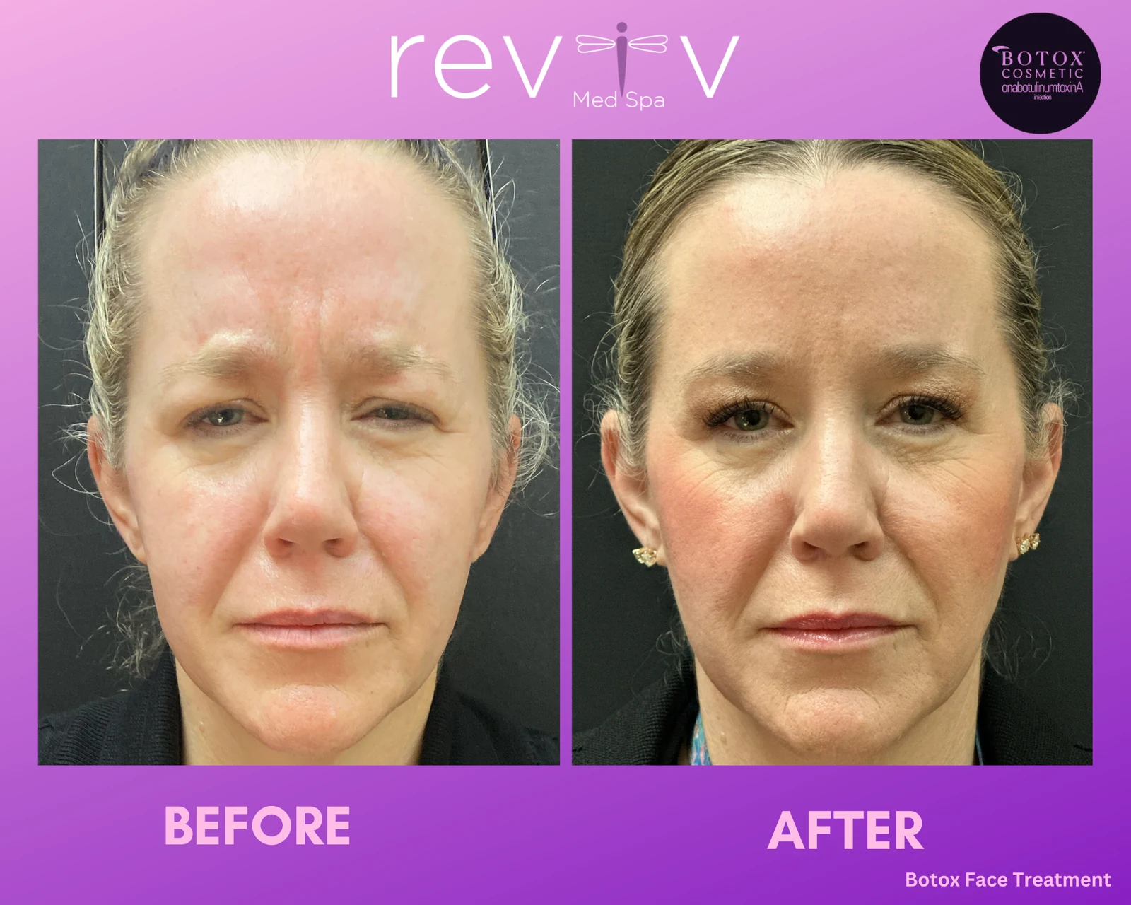 Reviv patient — Botox (undefined)