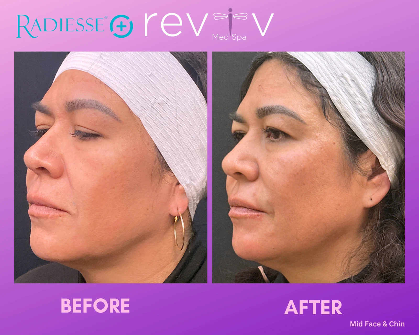 Reviv patient — Dermal Fillers (undefined)