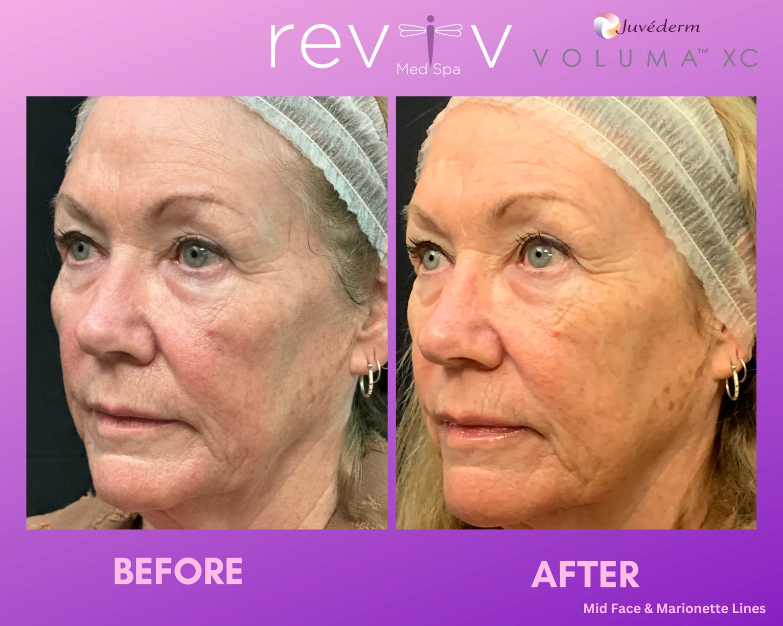 Reviv patient — Dermal Fillers (undefined)