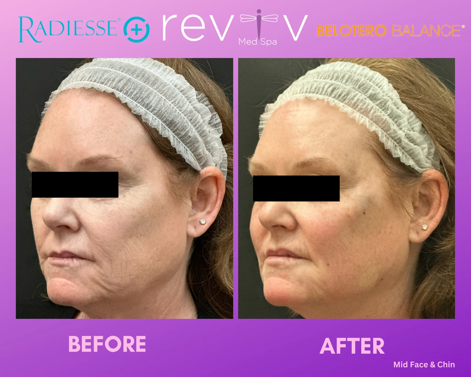 Reviv patient — Dermal Fillers (undefined)