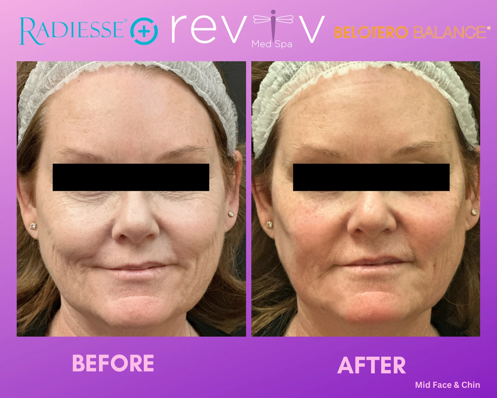 Reviv patient — Dermal Fillers (undefined)